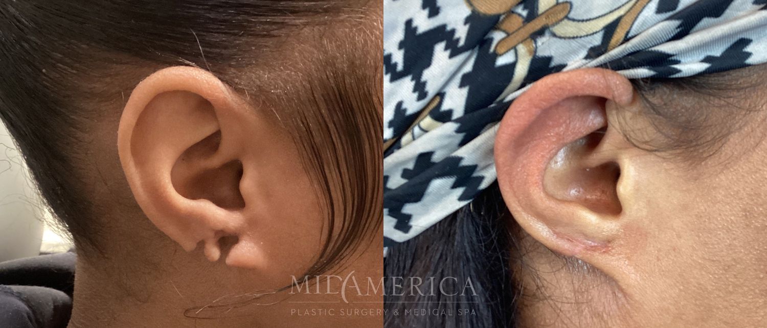 Earlobe Repair Before & After