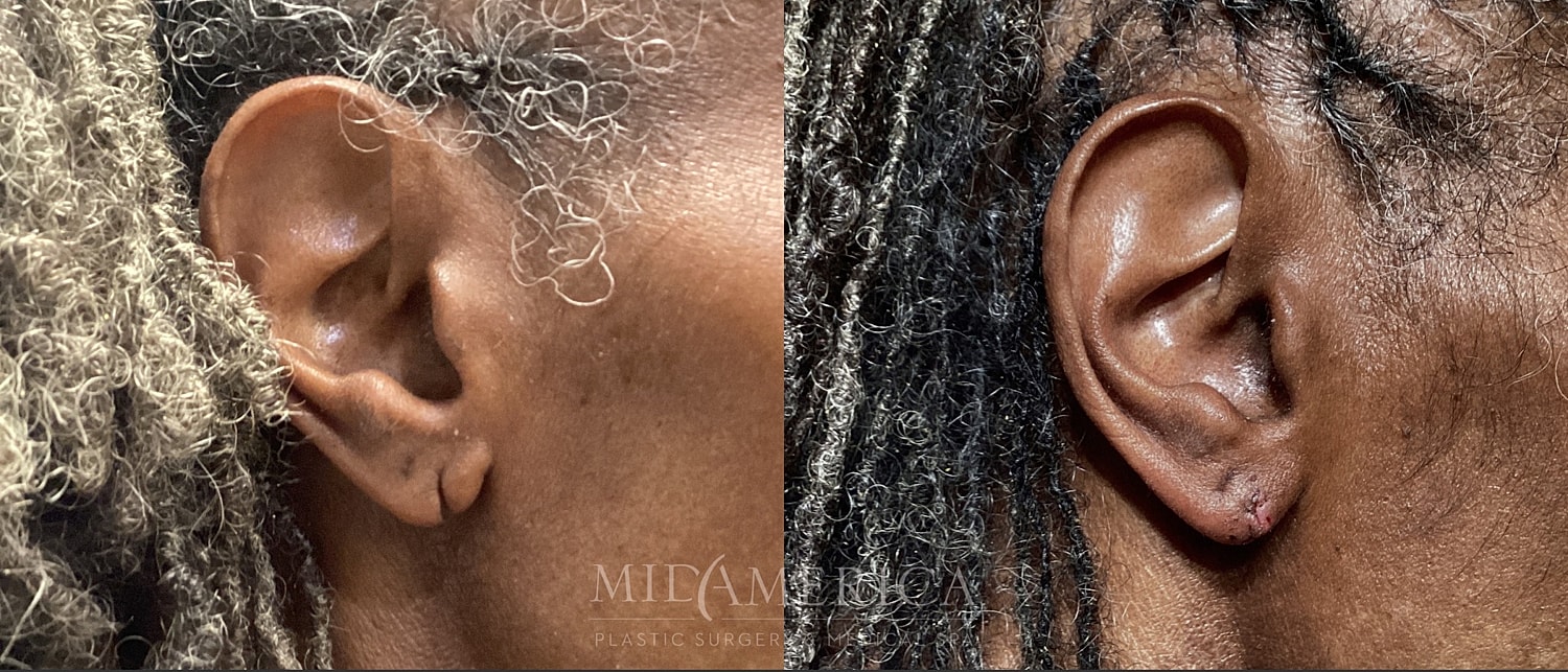 Earlobe Repair Before & After