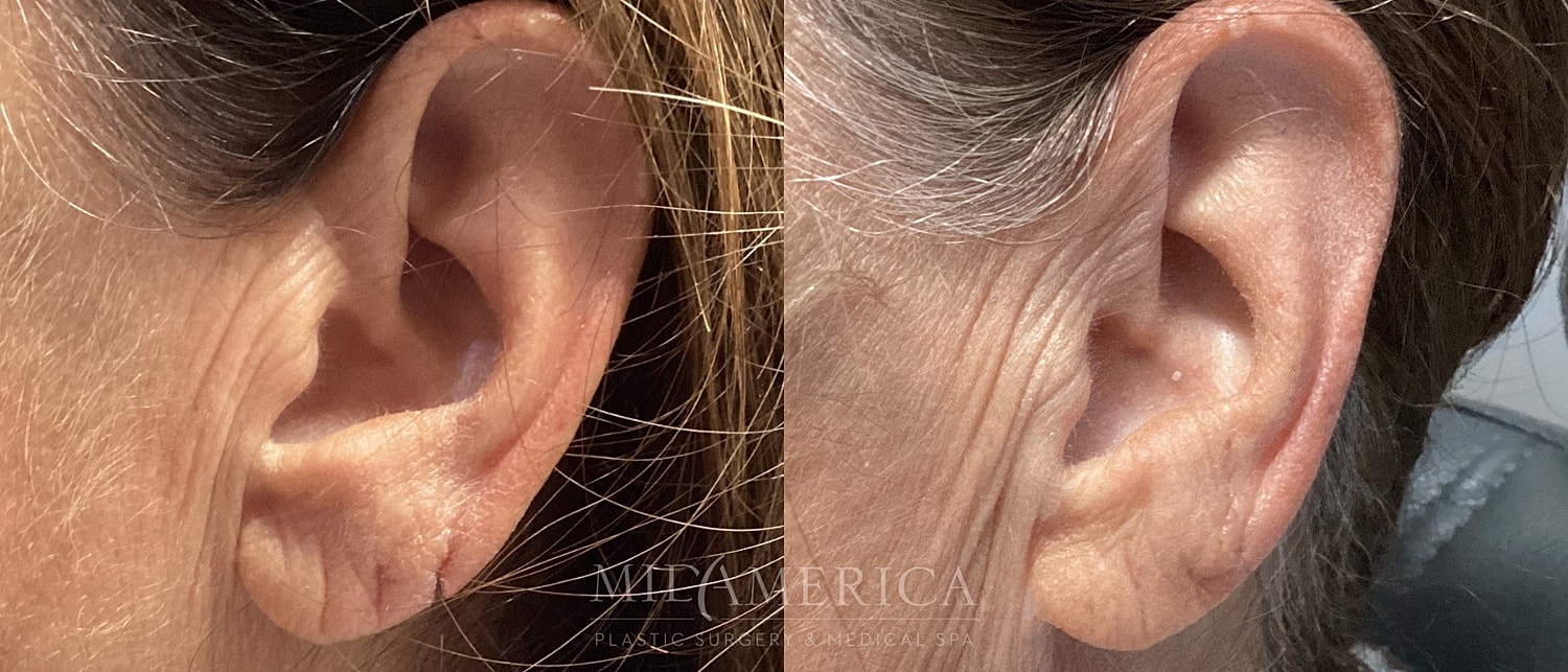 Earlobe Repair Before & After