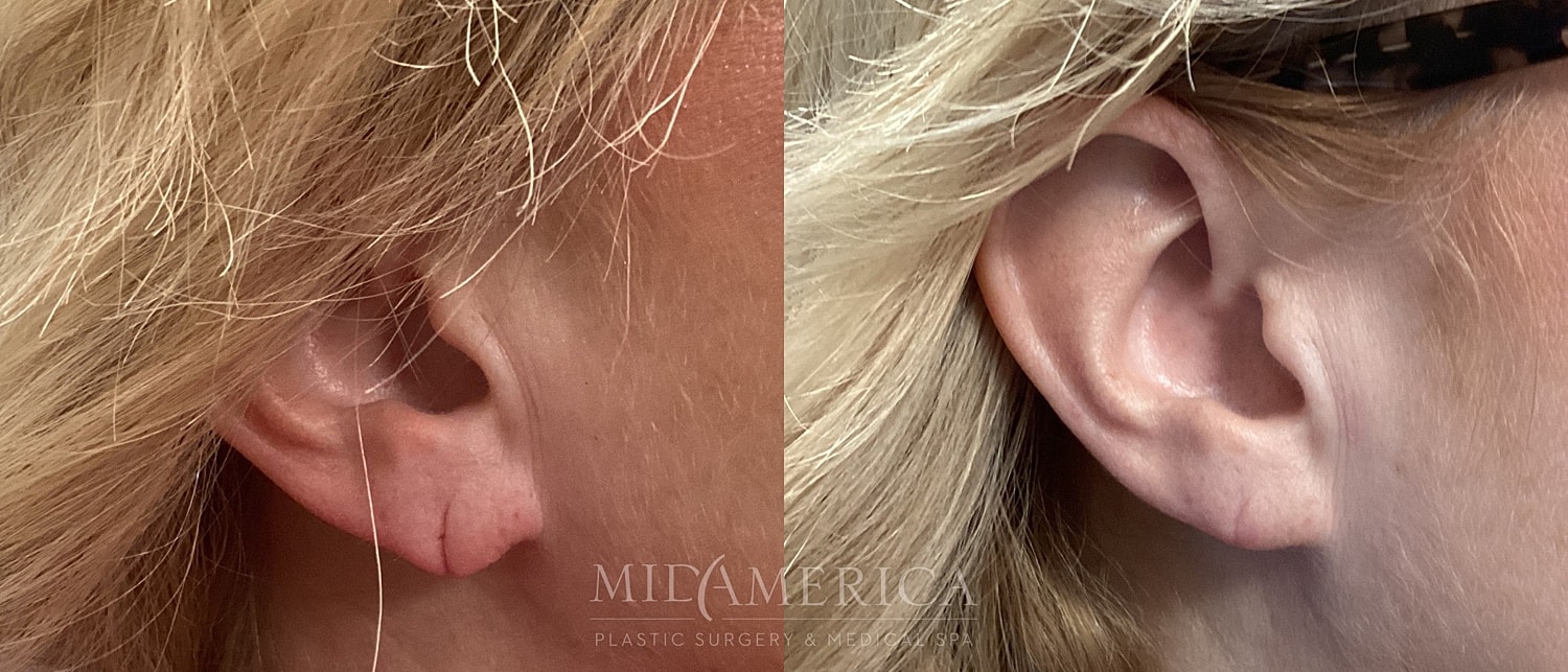 Earlobe Repair Before & After