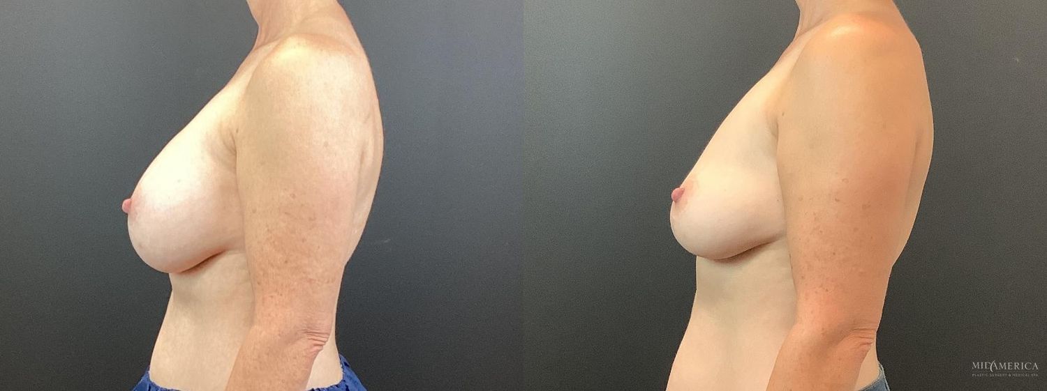 Implant Removal Before & After