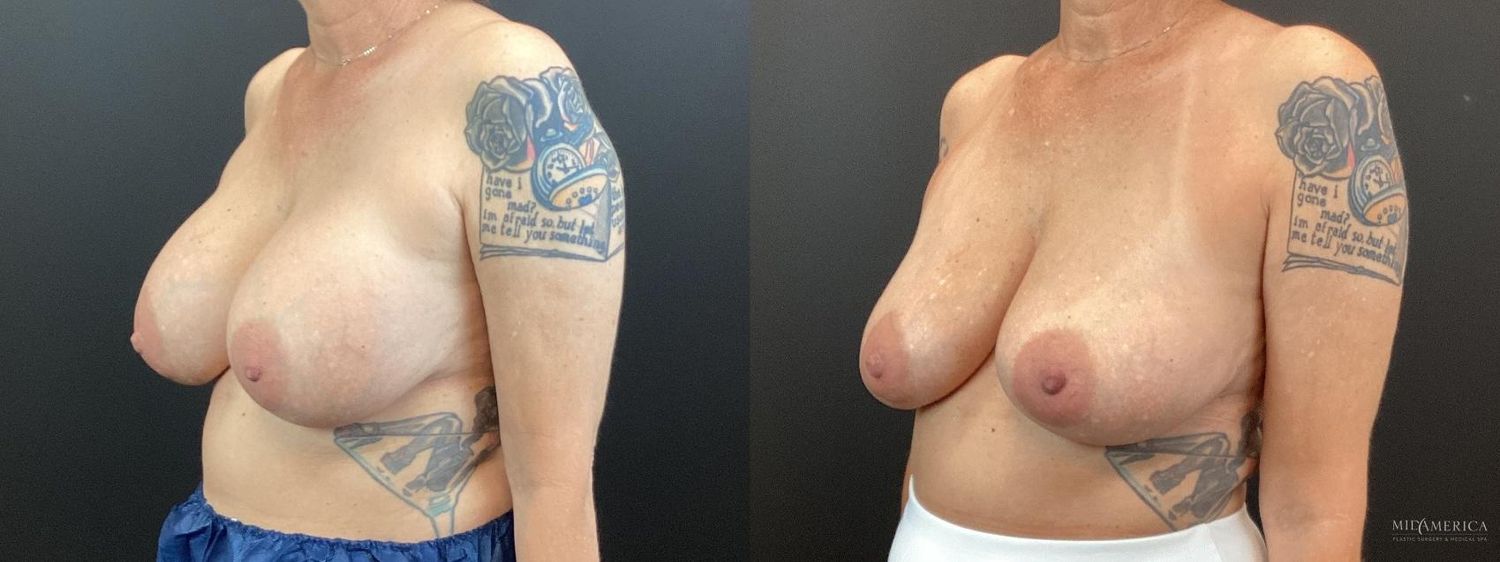 Implant Removal Before & After