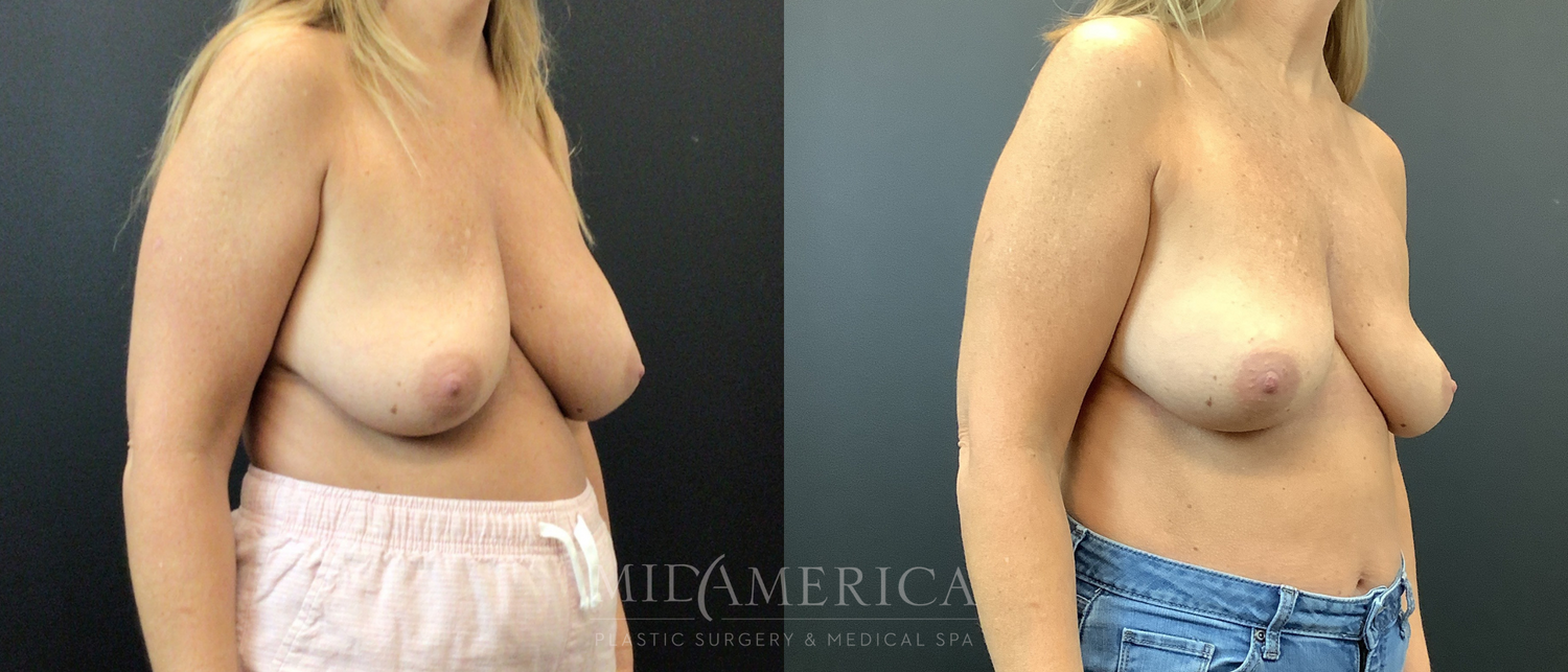 Implant Removal Before & After