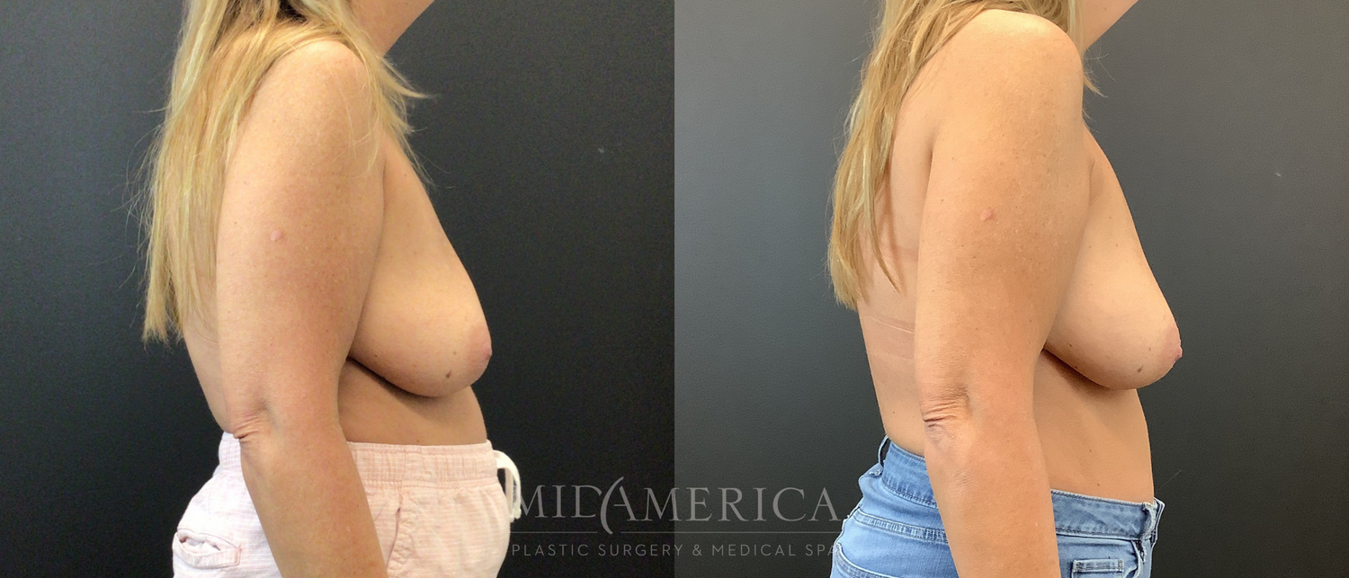 Implant Removal Before & After