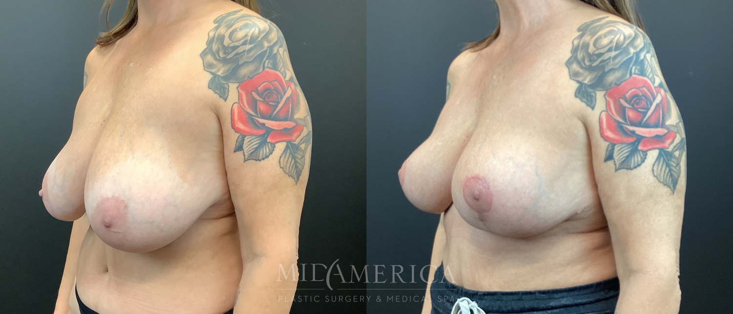 Implant Removal Before & After