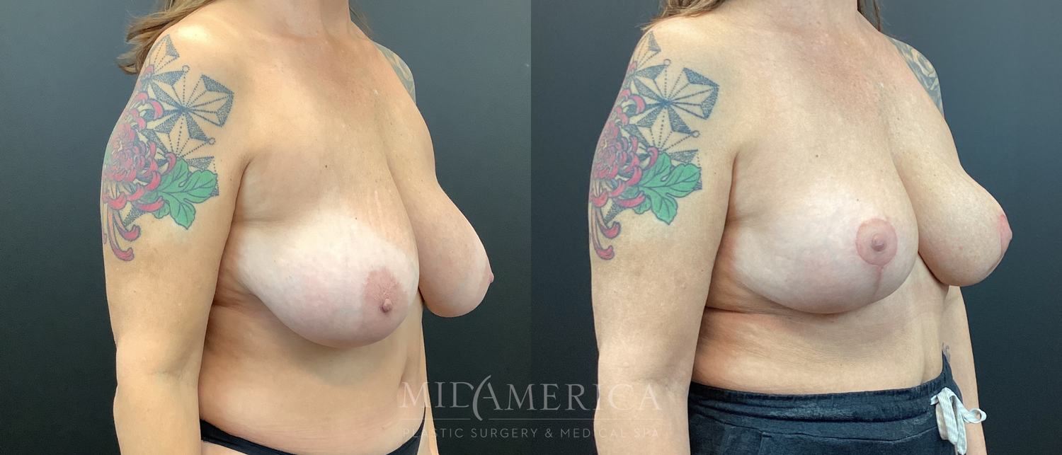 Implant Removal Before & After