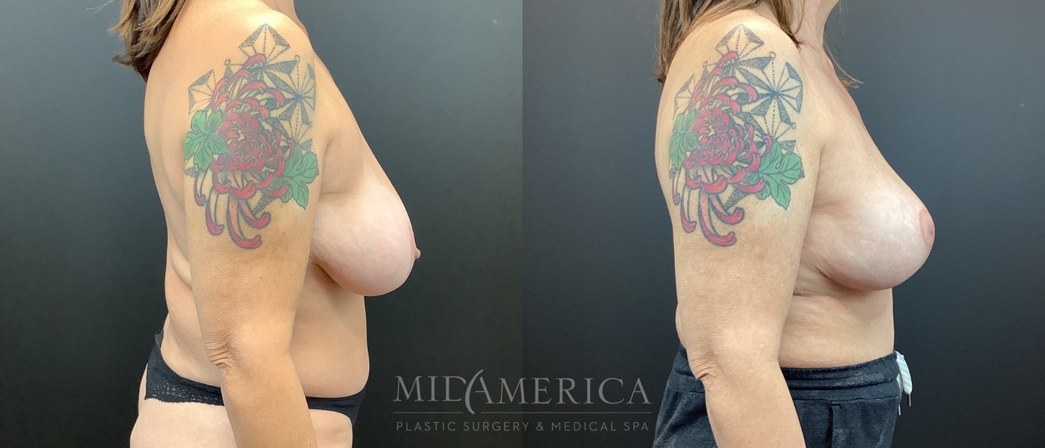 Implant Removal Before & After