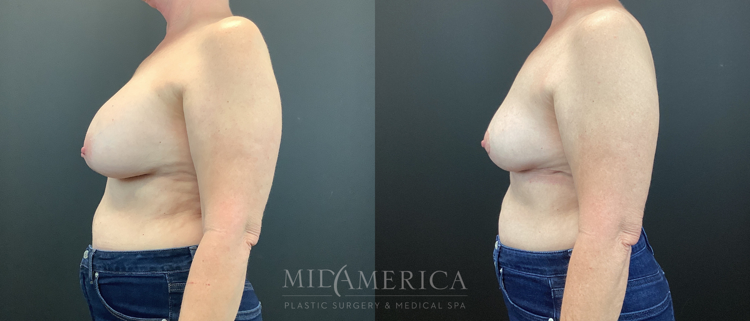 Implant Removal Before & After