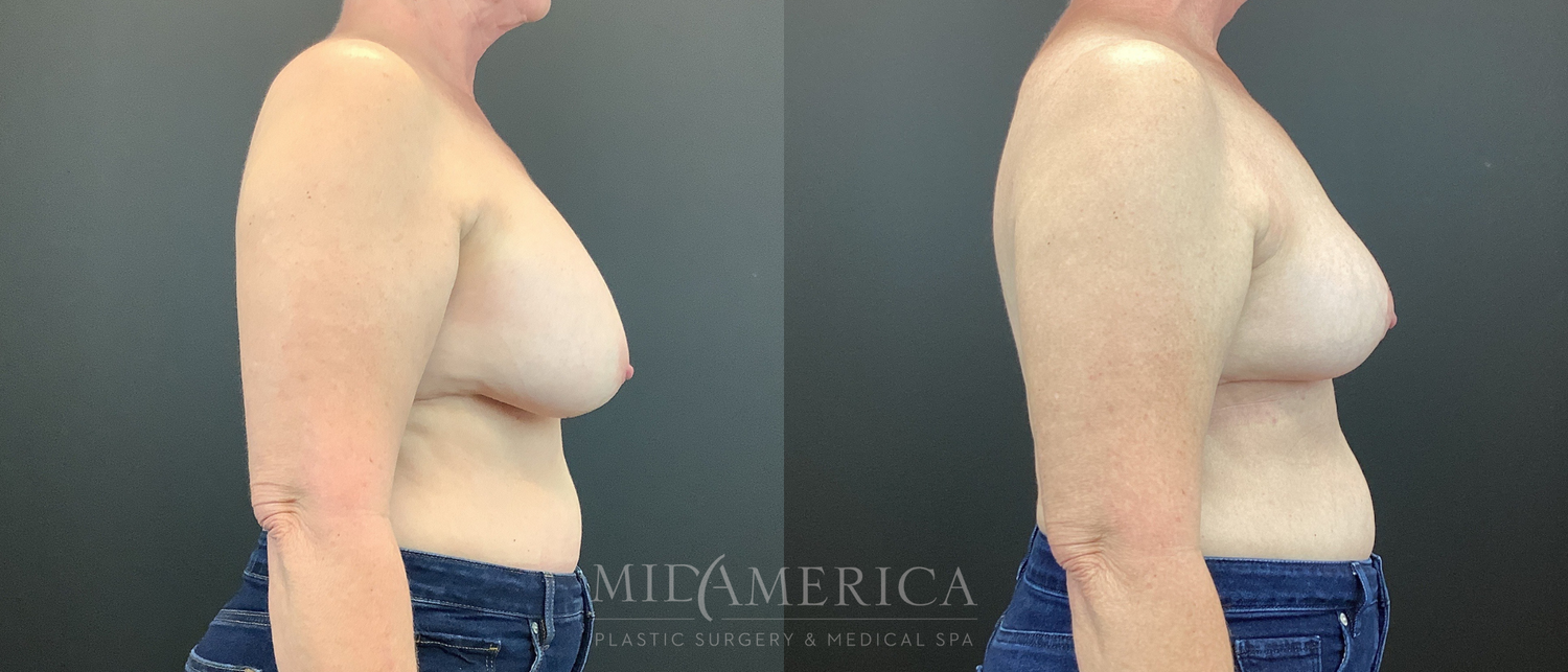 Implant Removal Before & After