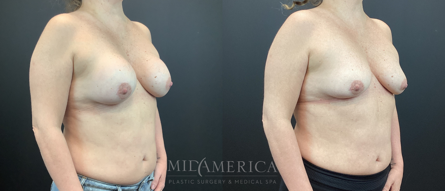 Implant Removal Before & After