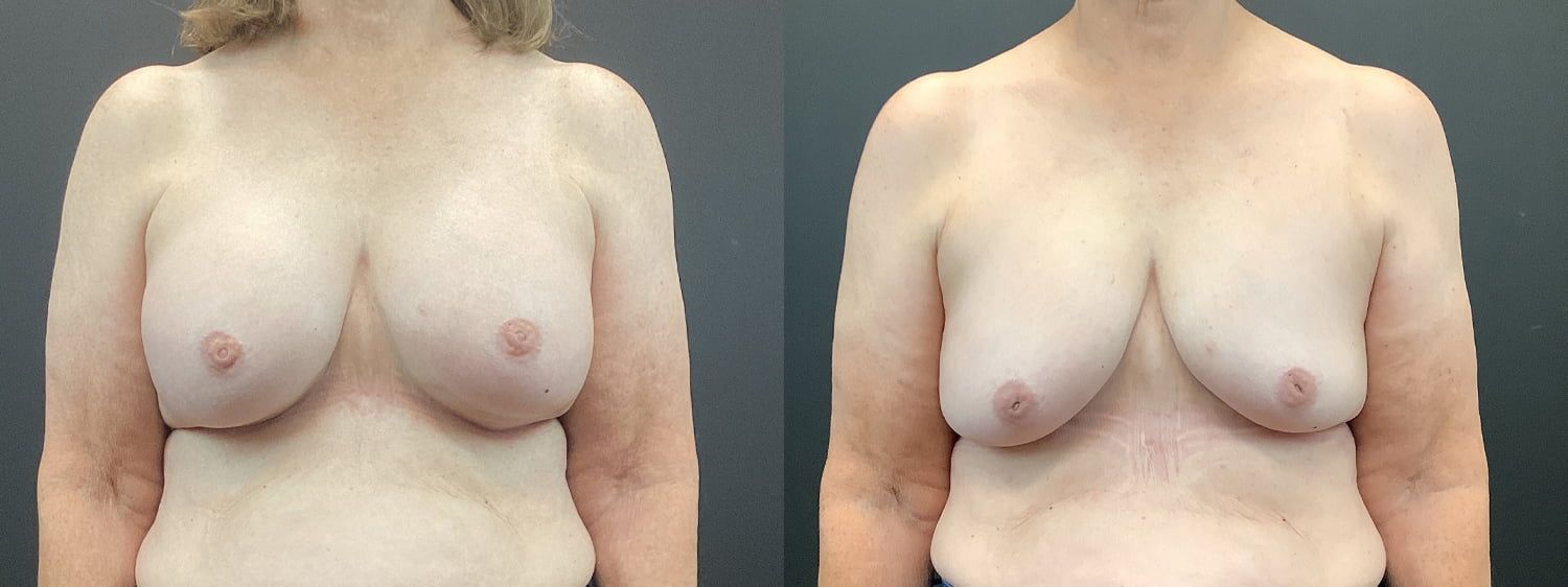 Implant Removal Before & After