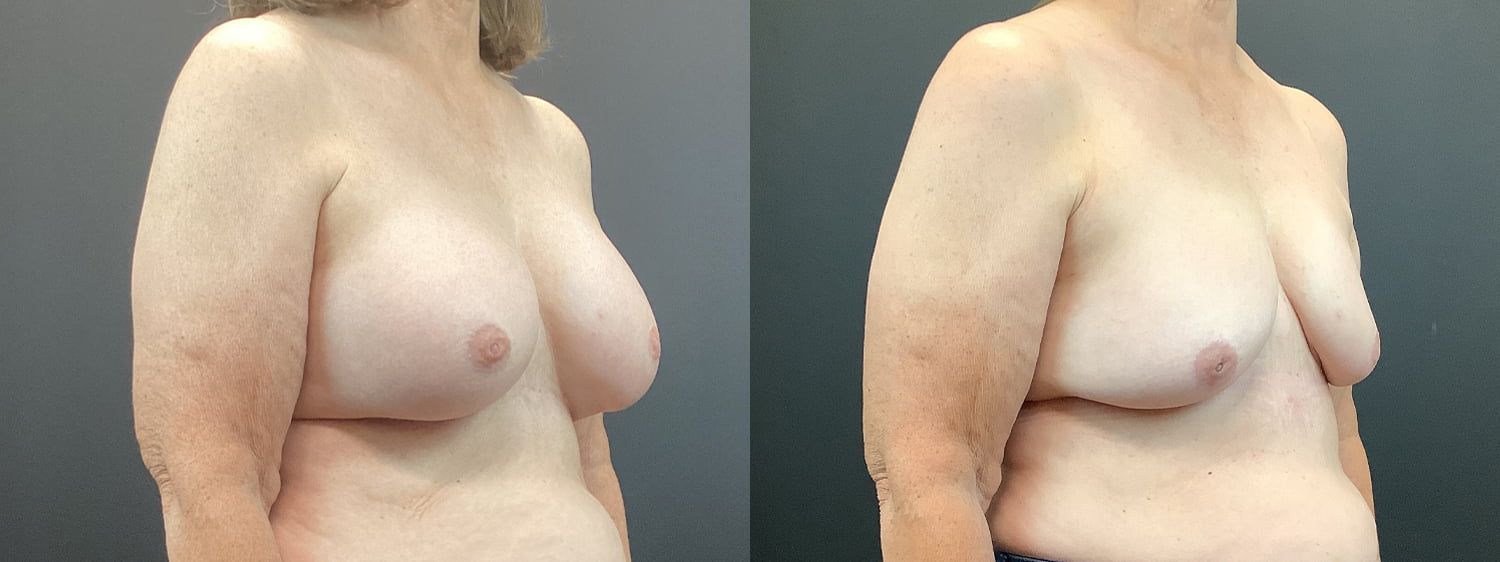 Implant Removal Before & After