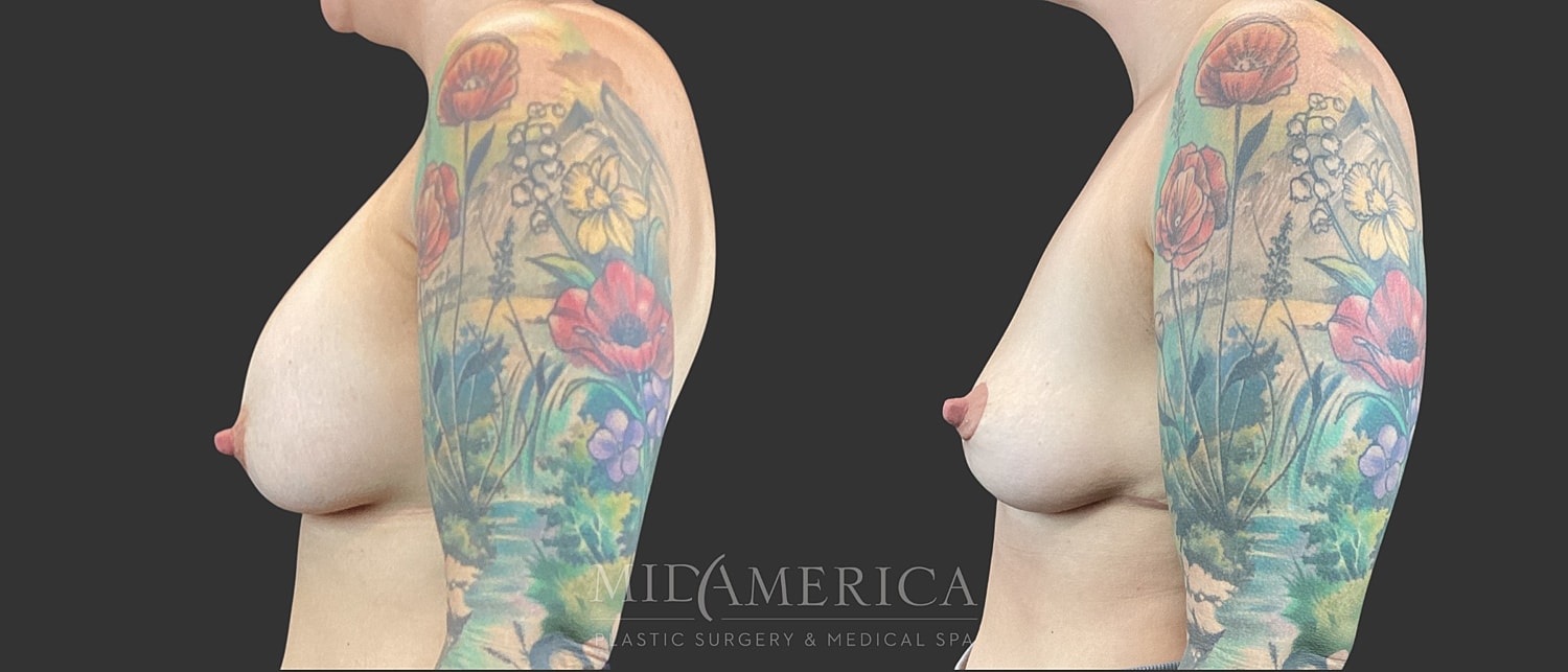 Implant Removal Before & After