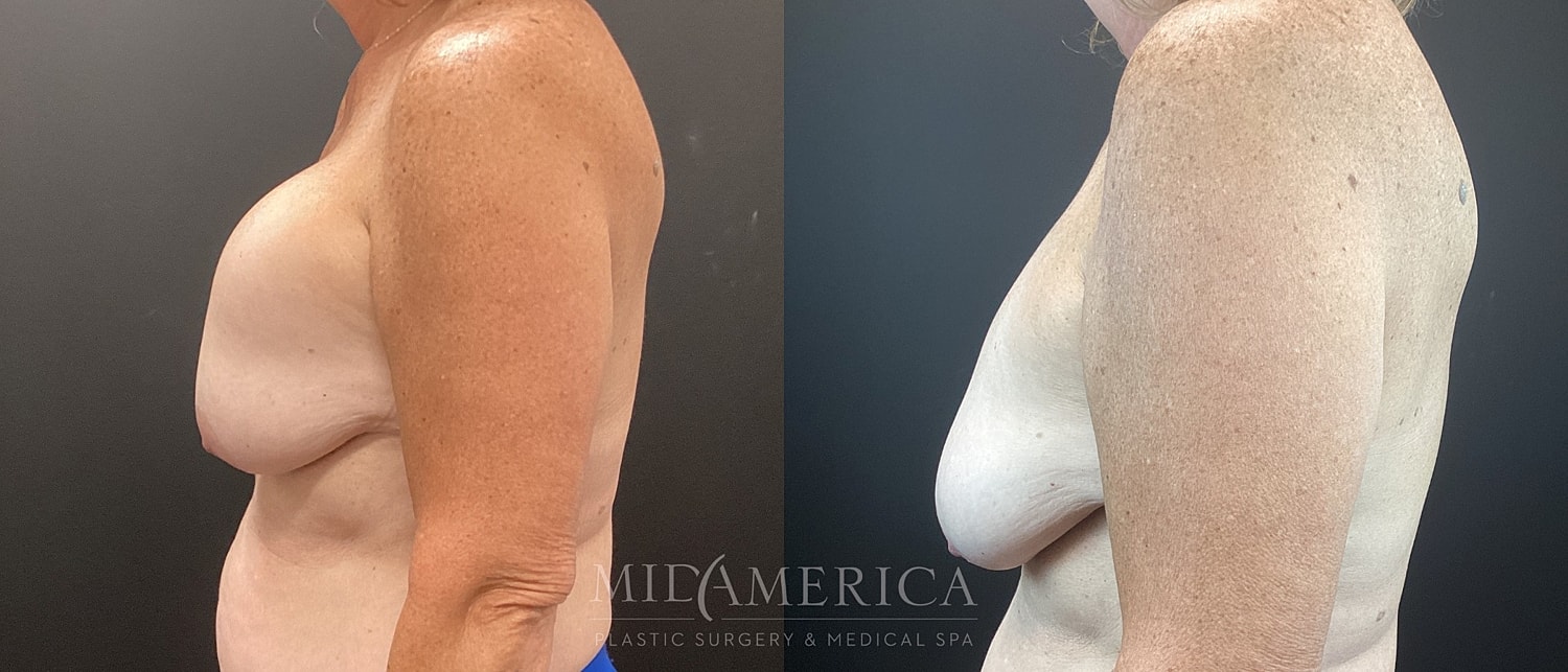 Implant Removal Before & After