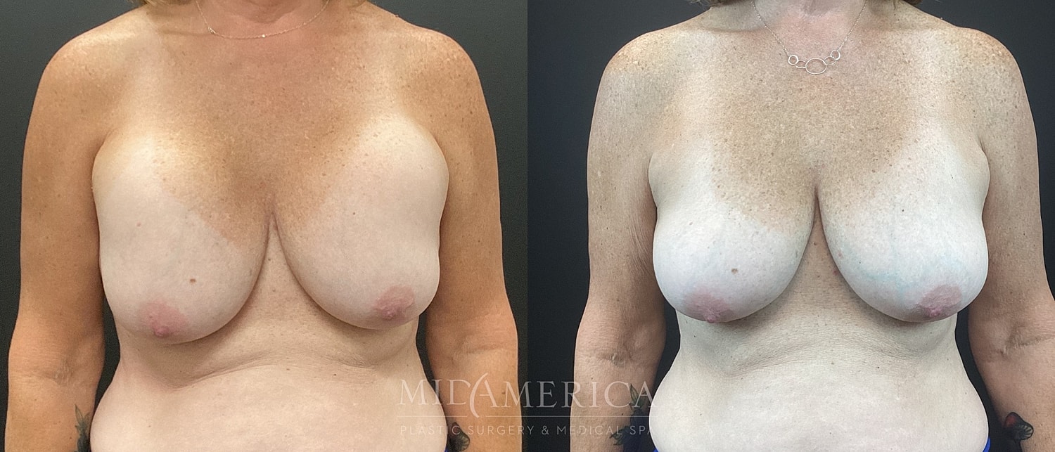 Implant Removal Before & After