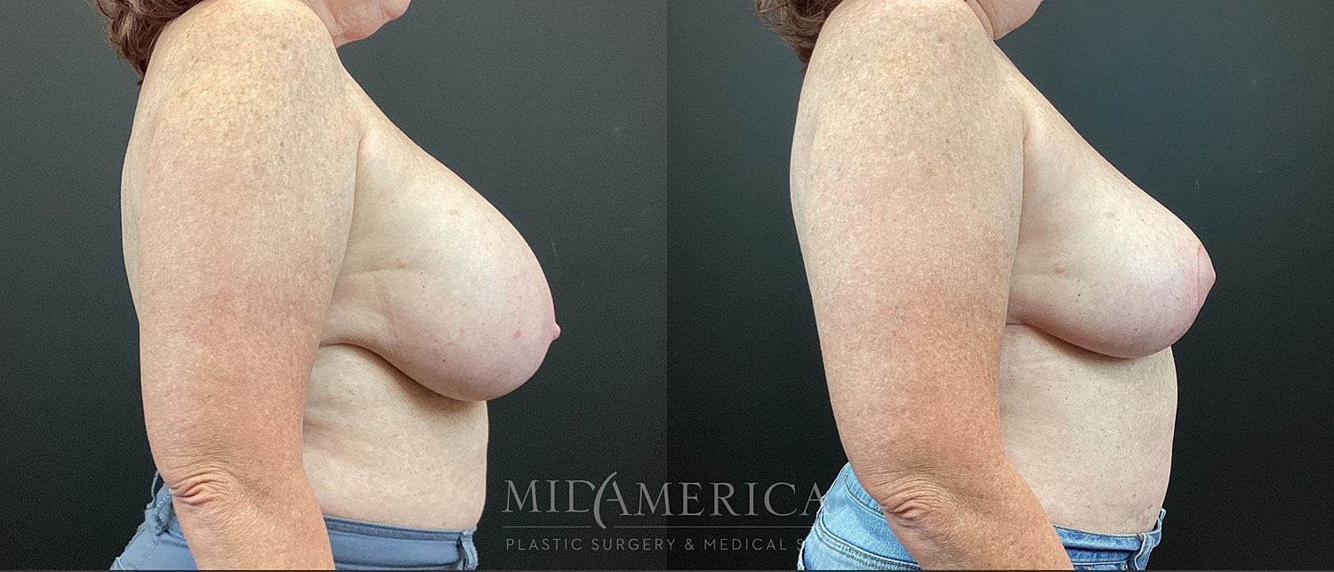 Implant Removal Before & After