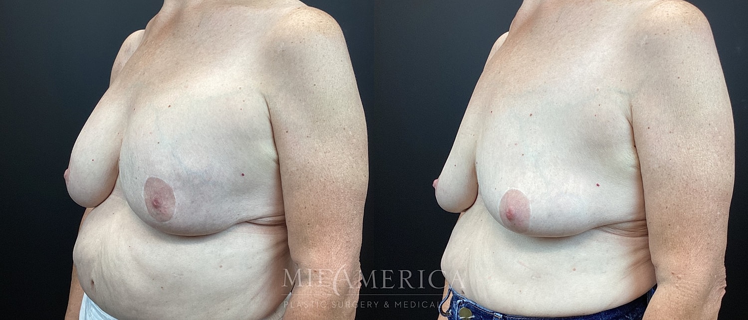 Breast reconstruction before and after photos.