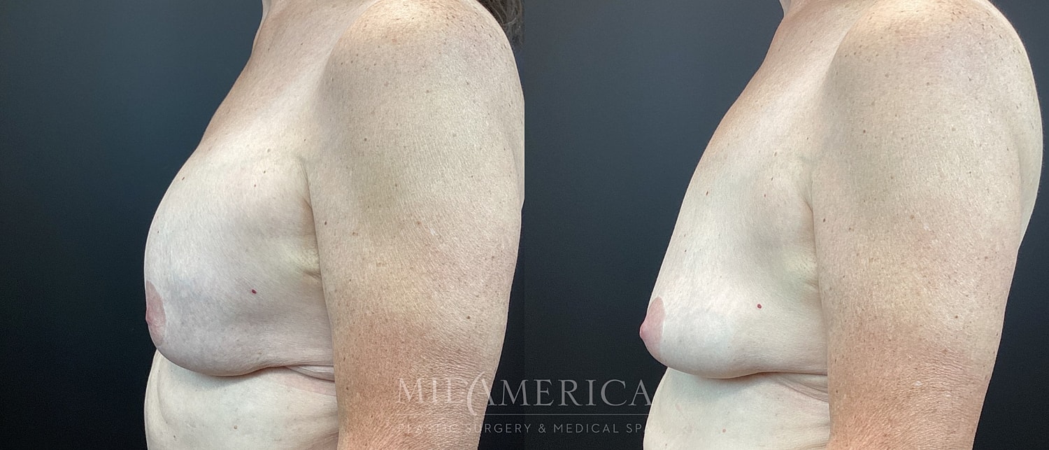 Before and after breast enhancement surgery comparison.