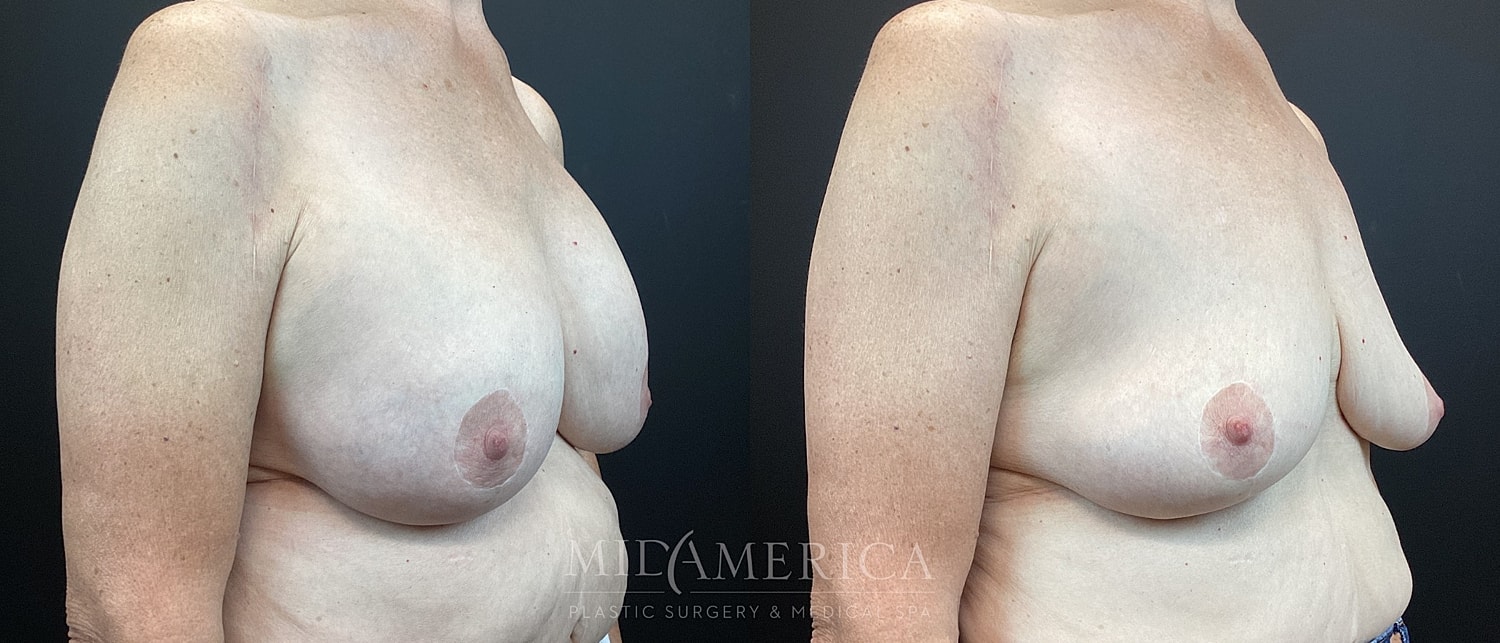 Before and after breast surgery comparison image.