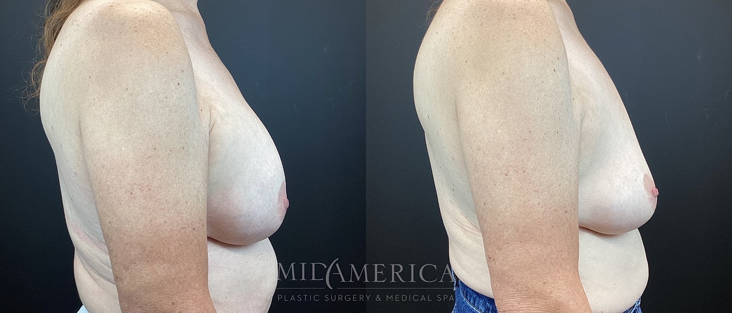 Implant Removal Before & After