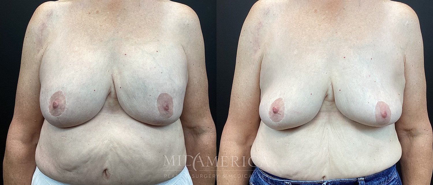 Before and after breast surgery comparison image.