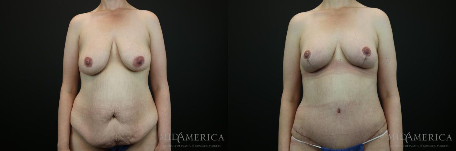 Mommy Makeover Before & After