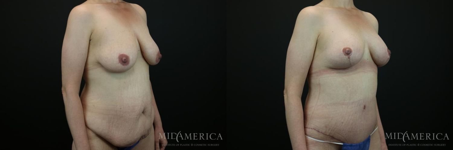 Mommy Makeover Before & After