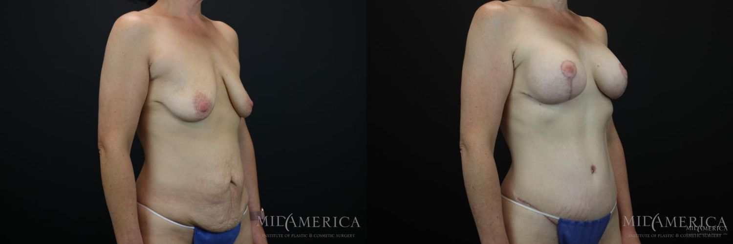 Mommy Makeover Before & After