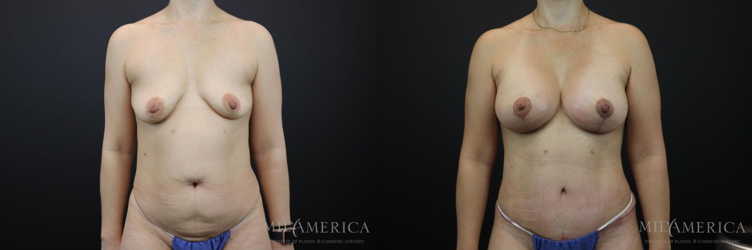 Mommy Makeover Before & After