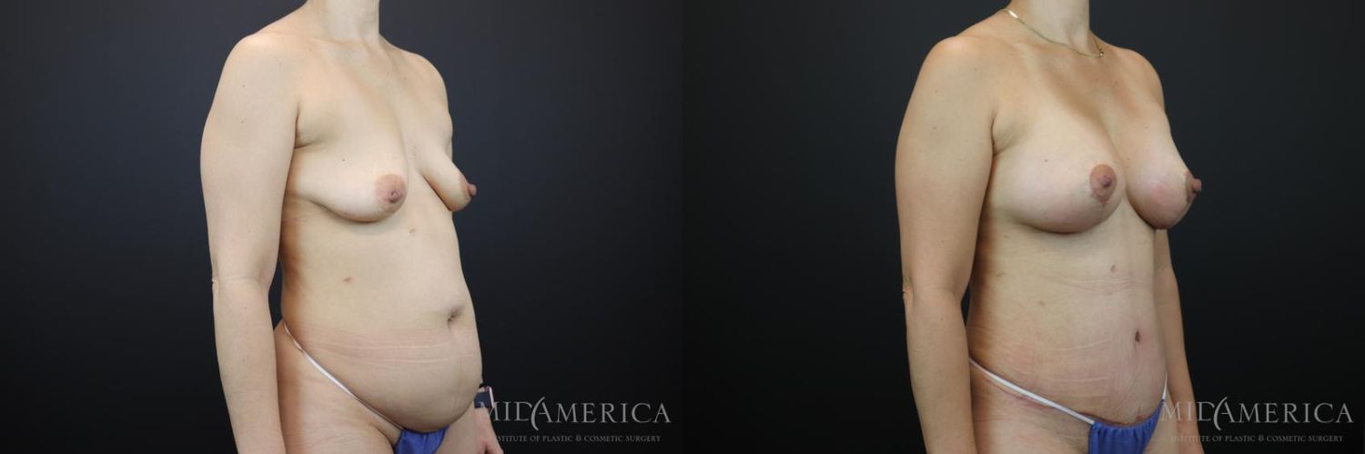 Mommy Makeover Before & After