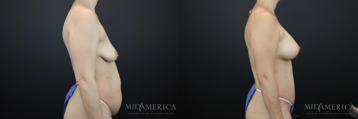 Mommy Makeover Before & After