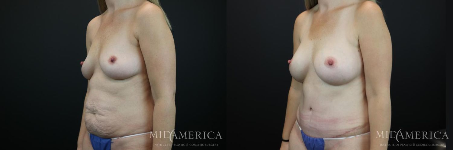 Mommy Makeover Before & After