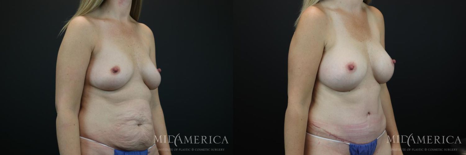 Mommy Makeover Before & After