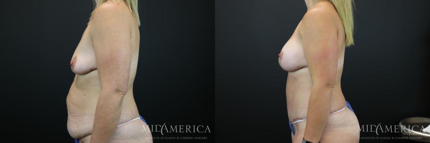 Mommy Makeover Before & After