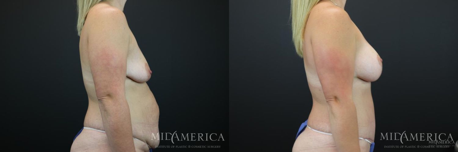 Mommy Makeover Before & After