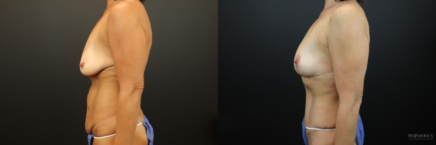 Mommy Makeover Before & After