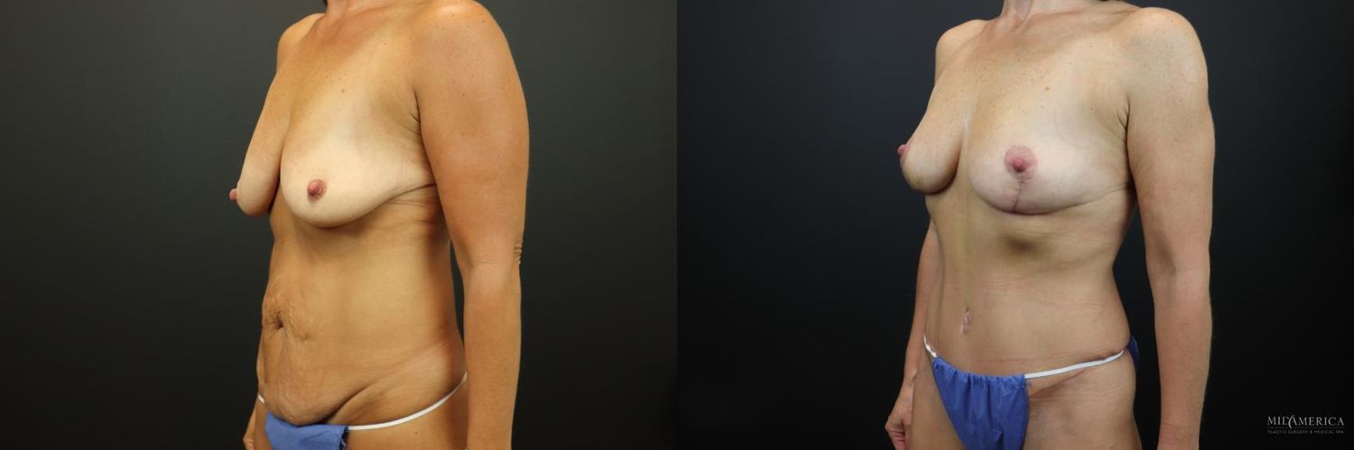 Mommy Makeover Before & After