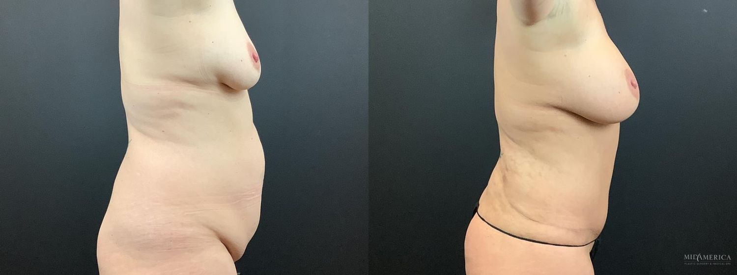 Mommy Makeover Before & After