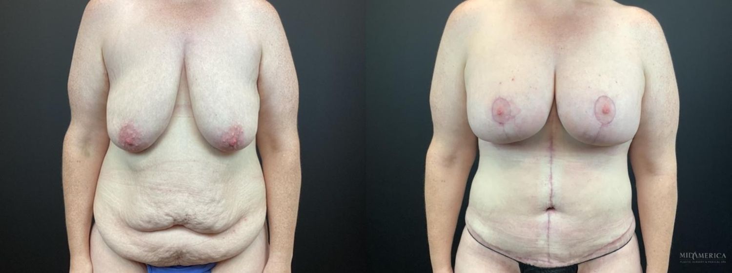 Mommy Makeover Before & After