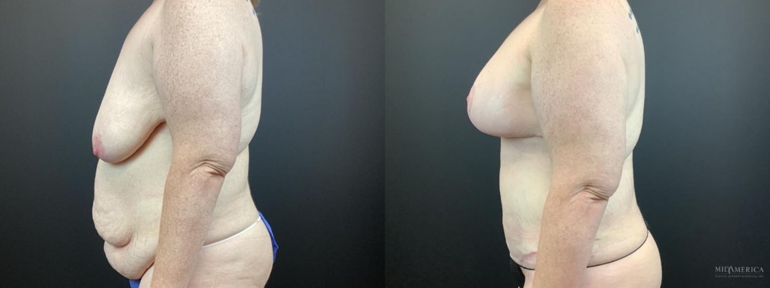 Mommy Makeover Before & After