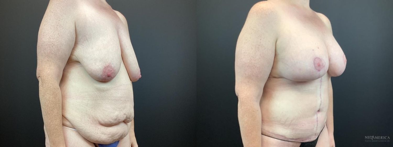 Mommy Makeover Before & After