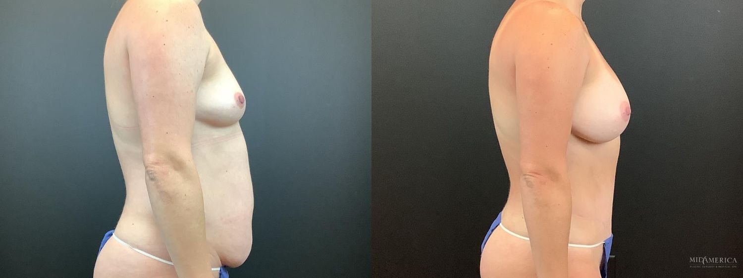 Mommy Makeover Before & After