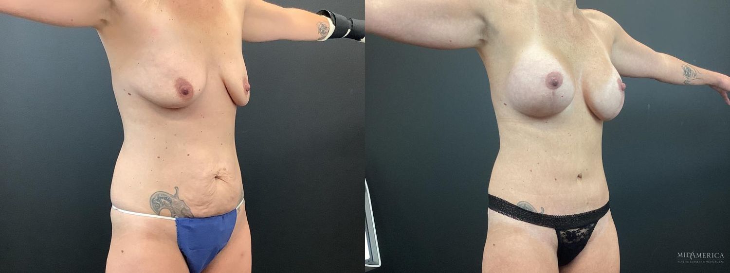 Mommy Makeover Before & After