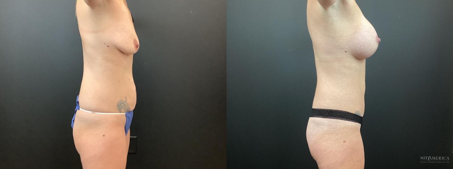 Mommy Makeover Before & After