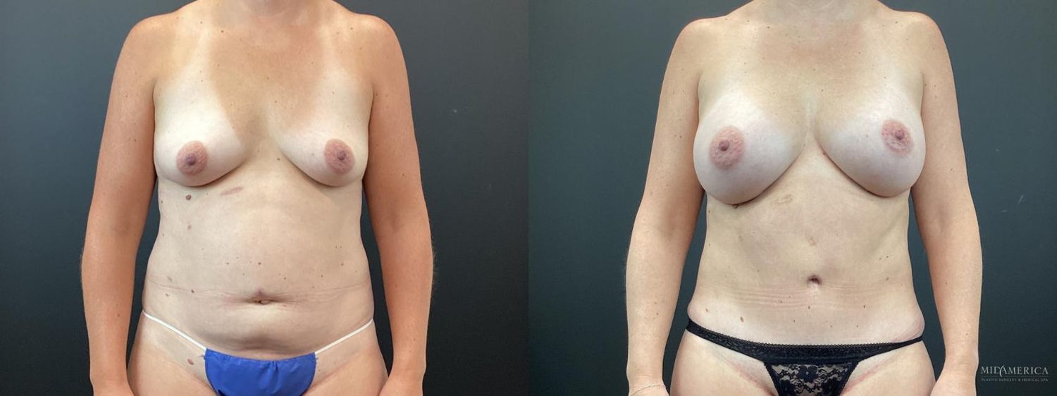 Mommy Makeover Before & After