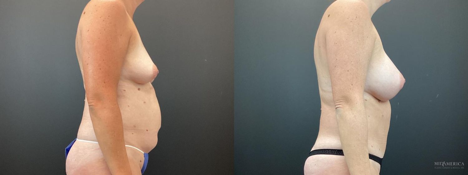 Mommy Makeover Before & After