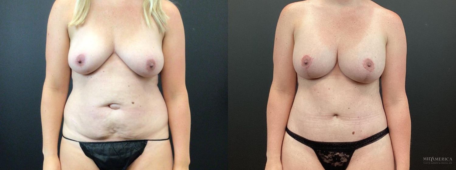 Mommy Makeover Before & After