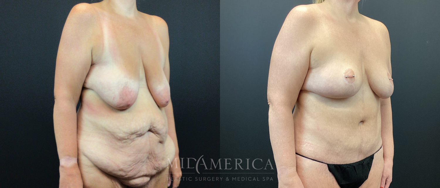 Mommy Makeover Before & After