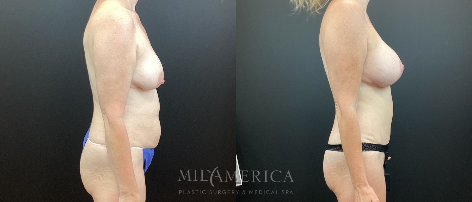 Mommy Makeover Before & After