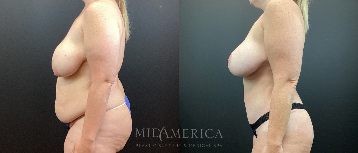 Mommy Makeover Before & After